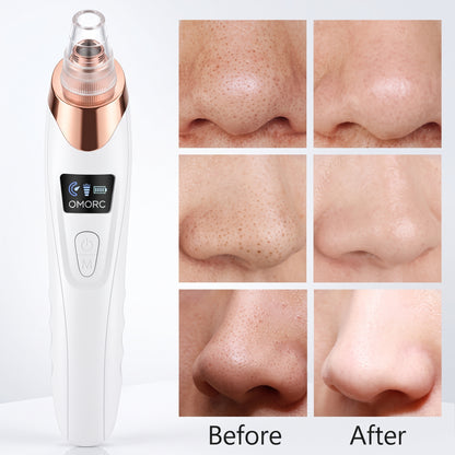 Rechargeable Blackhead Remover Vacuum – 5-Level Pore Cleaner with 4 Suction Heads