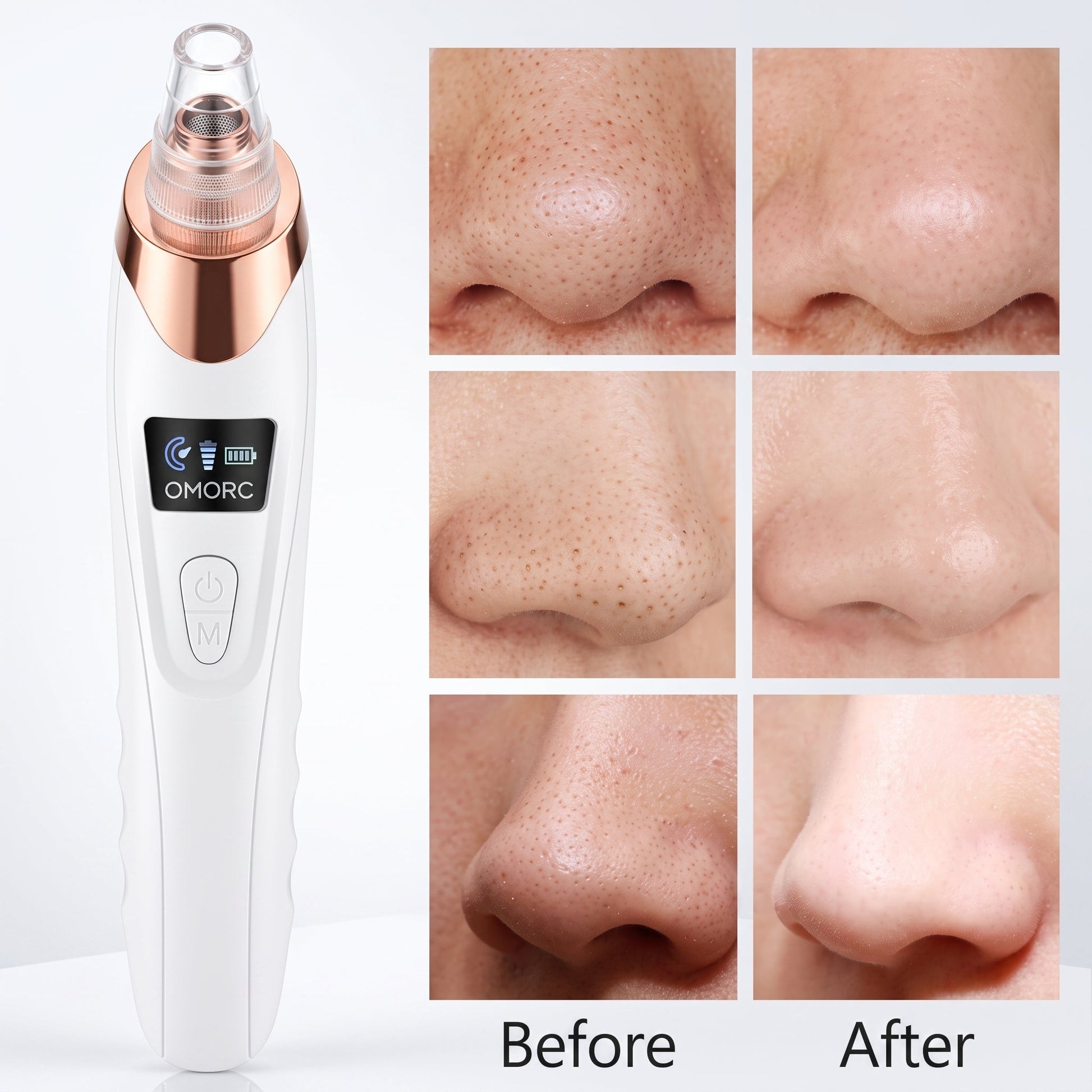 Rechargeable Blackhead Remover Vacuum – 5-Level Pore Cleaner with 4 Suction Heads - Armaa Store Pk